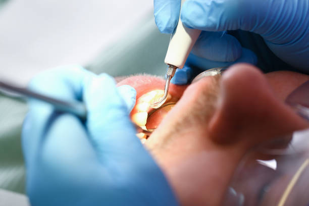 Best Emergency Tooth Extraction in Belleair Bluffs, FL